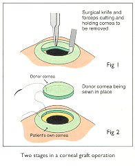 The corneal graft operation